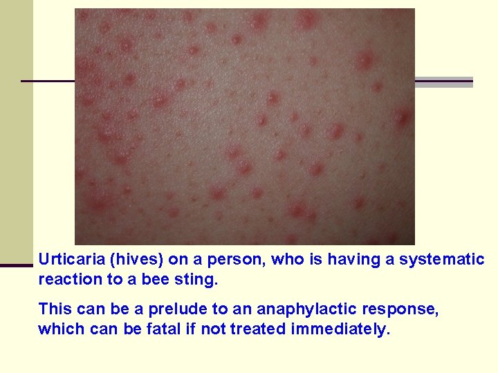 Urticaria (hives) on a person, who is having a systematic reaction to a bee