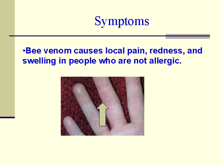 Symptoms • Bee venom causes local pain, redness, and swelling in people who are