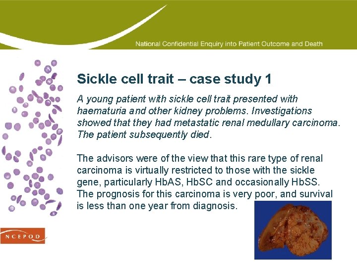 Sickle cell trait – case study 1 A young patient with sickle cell trait