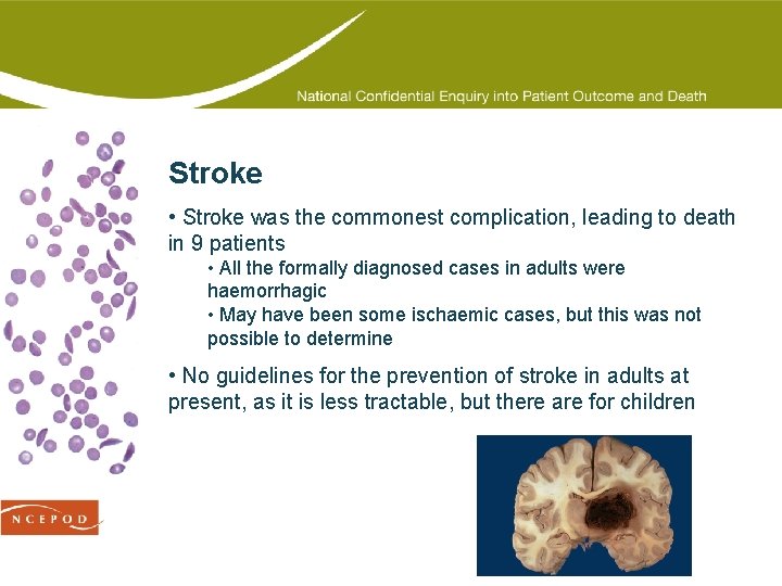 Stroke • Stroke was the commonest complication, leading to death in 9 patients •