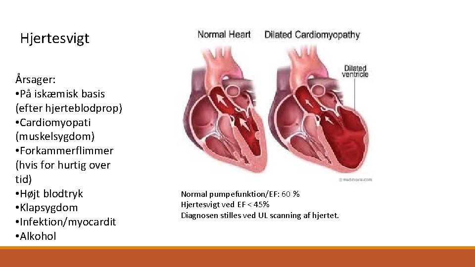 Hjertesvigt Årsager: • På iskæmisk basis (efter hjerteblodprop) • Cardiomyopati (muskelsygdom) • Forkammerflimmer (hvis