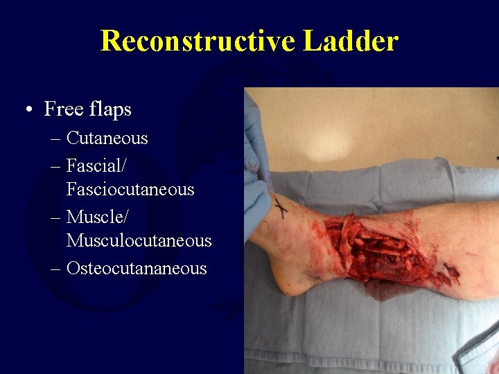 Reconstructive Ladder • Free flaps – Cutaneous – Fascial/ Fasciocutaneous – Muscle/ Musculocutaneous –