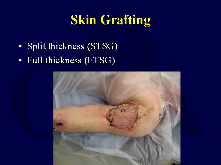 Skin Grafting • Split thickness (STSG) • Full thickness (FTSG) 