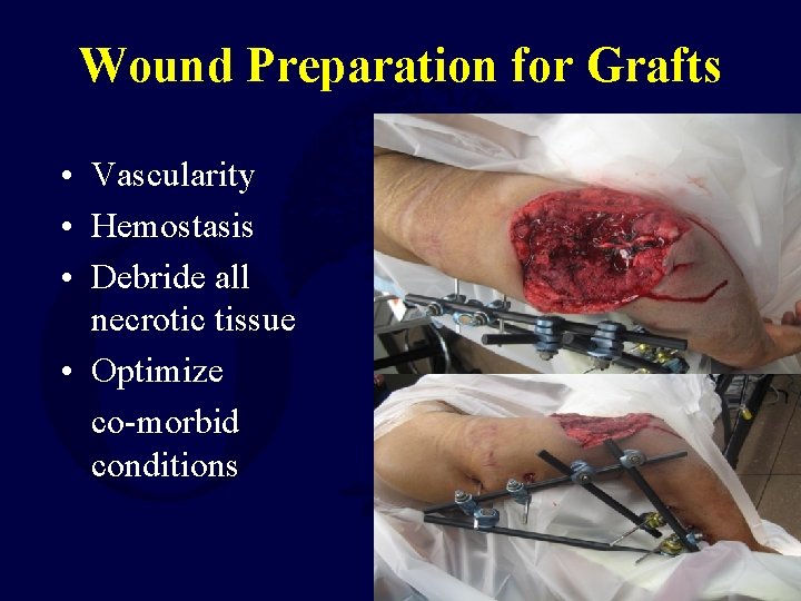 Wound Preparation for Grafts • Vascularity • Hemostasis • Debride all necrotic tissue •