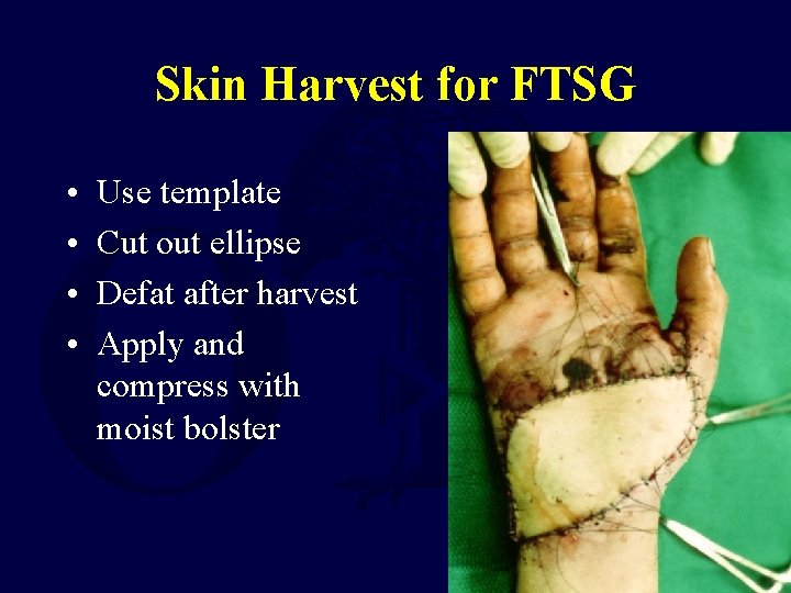 Skin Harvest for FTSG • • Use template Cut out ellipse Defat after harvest