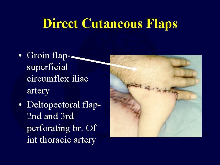 Direct Cutaneous Flaps • Groin flapsuperficial circumflex iliac artery • Deltopectoral flap 2 nd