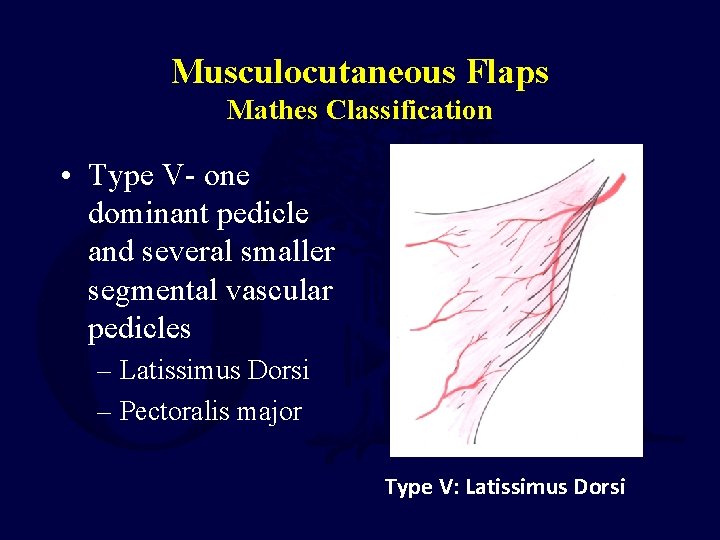 Musculocutaneous Flaps Mathes Classification • Type V- one dominant pedicle and several smaller segmental
