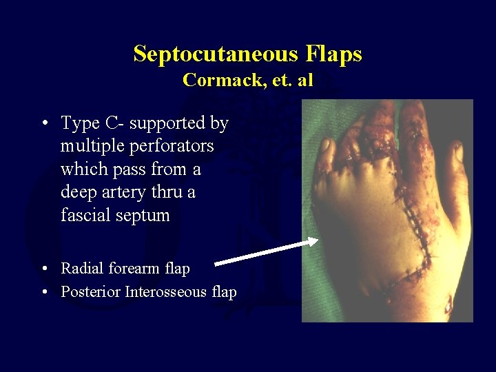 Septocutaneous Flaps Cormack, et. al • Type C- supported by multiple perforators which pass