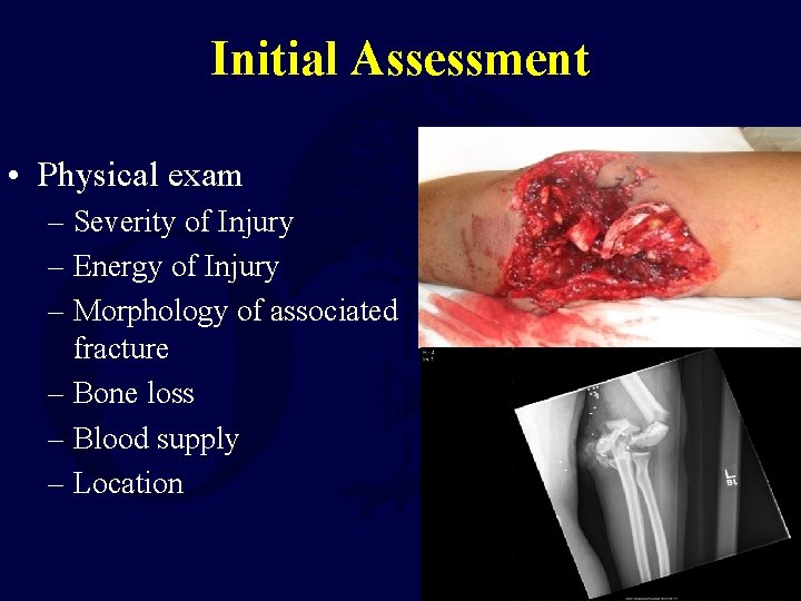 Initial Assessment • Physical exam – Severity of Injury – Energy of Injury –
