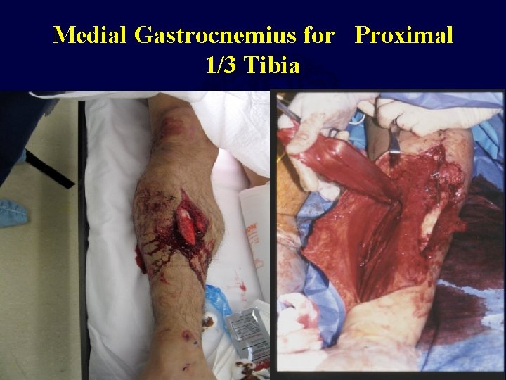Medial Gastrocnemius for Proximal 1/3 Tibia 
