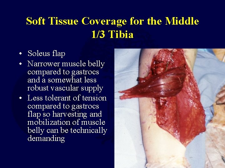 Soft Tissue Coverage for the Middle 1/3 Tibia • Soleus flap • Narrower muscle