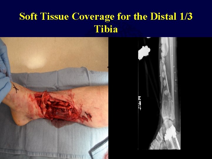 Soft Tissue Coverage for the Distal 1/3 Tibia 