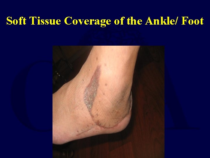 Soft Tissue Coverage of the Ankle/ Foot 
