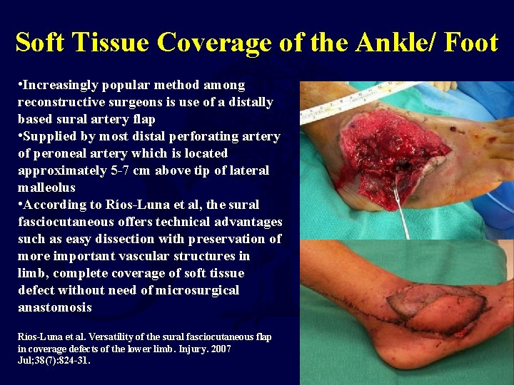 Soft Tissue Coverage of the Ankle/ Foot • Increasingly popular method among reconstructive surgeons
