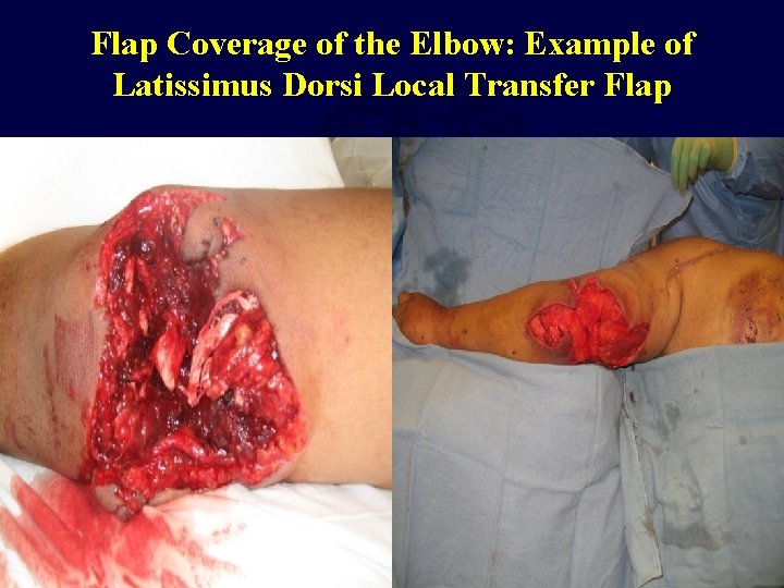 Flap Coverage of the Elbow: Example of Latissimus Dorsi Local Transfer Flap 