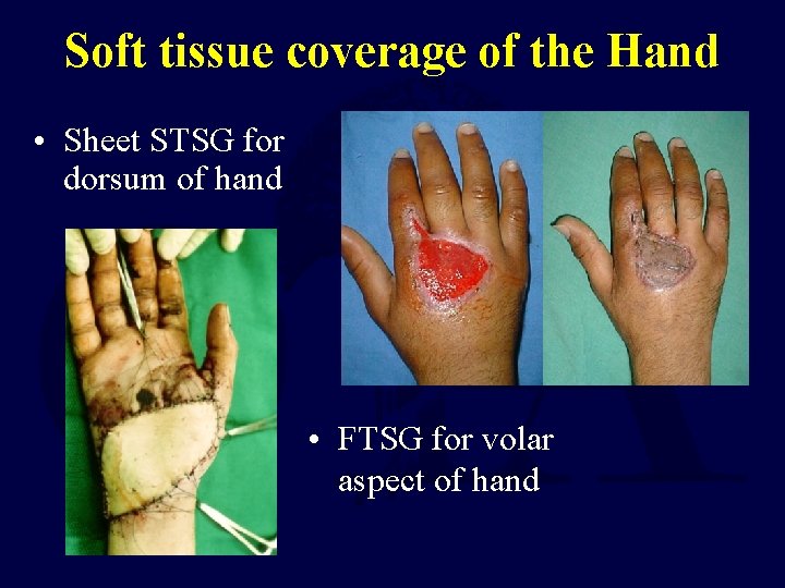 Soft tissue coverage of the Hand • Sheet STSG for dorsum of hand •