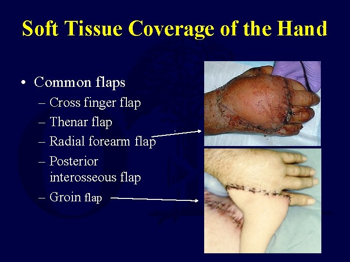 Soft Tissue Coverage of the Hand • Common flaps – Cross finger flap –