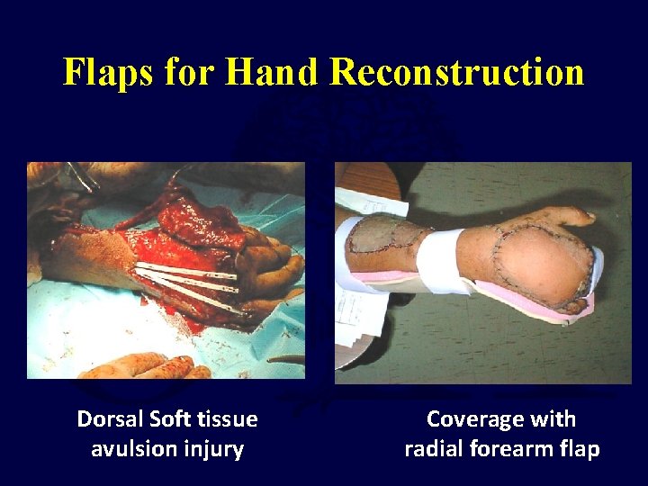 Flaps for Hand Reconstruction Dorsal Soft tissue avulsion injury Coverage with radial forearm flap