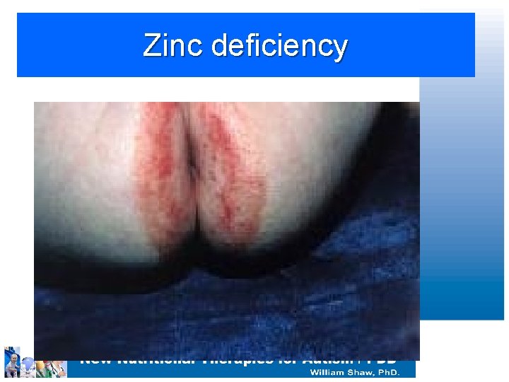 Zinc deficiency 