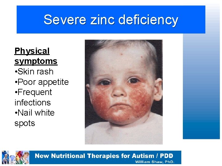 Severe zinc deficiency Physical symptoms • Skin rash • Poor appetite • Frequent infections