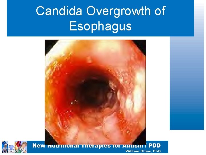 Candida Overgrowth of Esophagus 