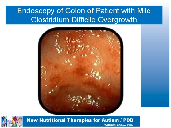 Endoscopy of Colon of Patient with Mild Clostridium Difficile Overgrowth 