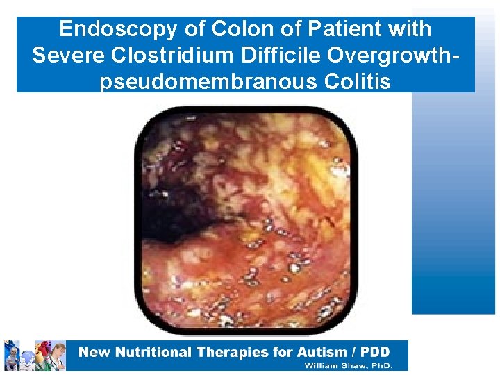 Endoscopy of Colon of Patient with Severe Clostridium Difficile Overgrowth- pseudomembranous Colitis 