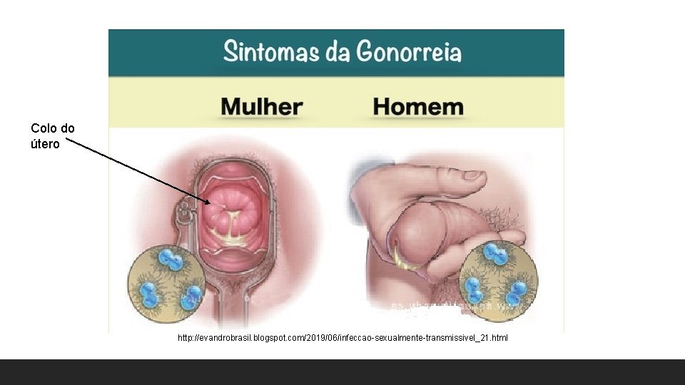 Colo do útero http: //evandrobrasil. blogspot. com/2019/06/infeccao-sexualmente-transmissivel_21. html Colo do útero http: //evandrobrasil. blogspot. com/2019/06/infeccao-sexualmente-transmissivel_21. html