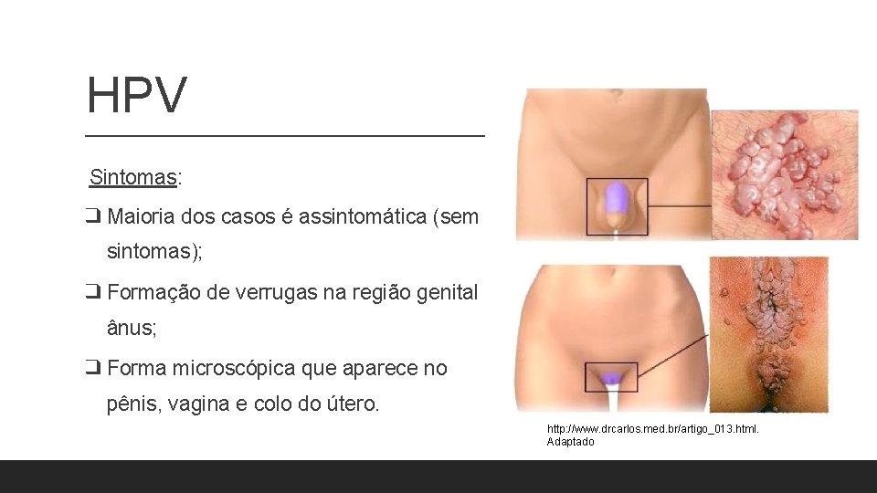 HPV Sintomas: ❑ Maioria dos casos é assintomática (sem sintomas); ❑ Formação de verrugas HPV Sintomas: ❑ Maioria dos casos é assintomática (sem sintomas); ❑ Formação de verrugas