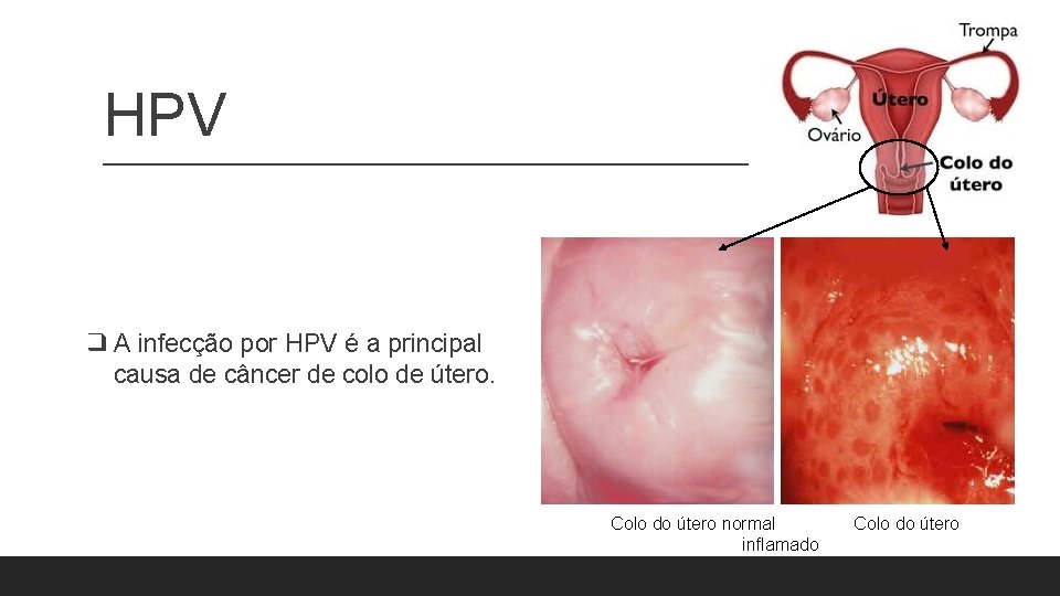 HPV ❑ A infecção por HPV é a principal causa de câncer de colo HPV ❑ A infecção por HPV é a principal causa de câncer de colo