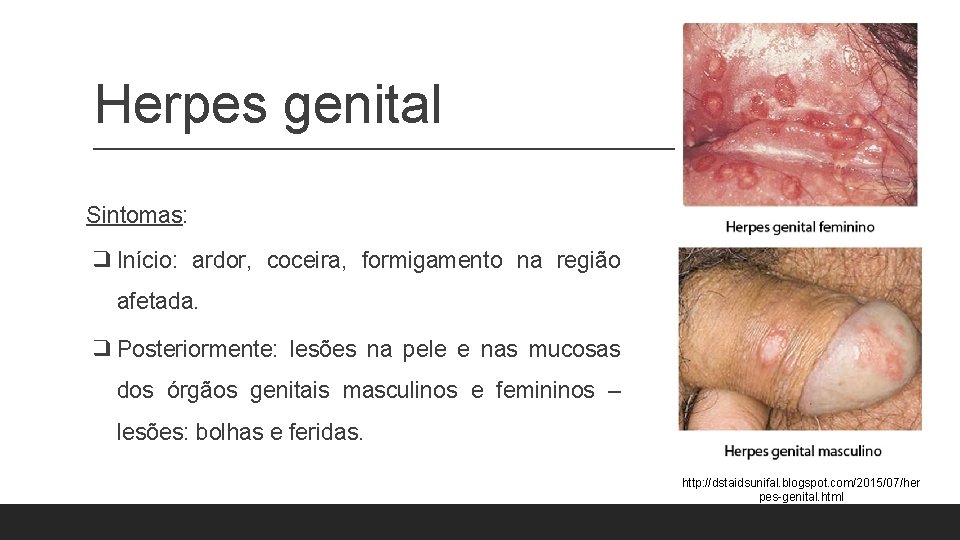 Herpes genital Sintomas: ❑ Início: ardor, coceira, formigamento na região afetada. ❑ Posteriormente: lesões Herpes genital Sintomas: ❑ Início: ardor, coceira, formigamento na região afetada. ❑ Posteriormente: lesões