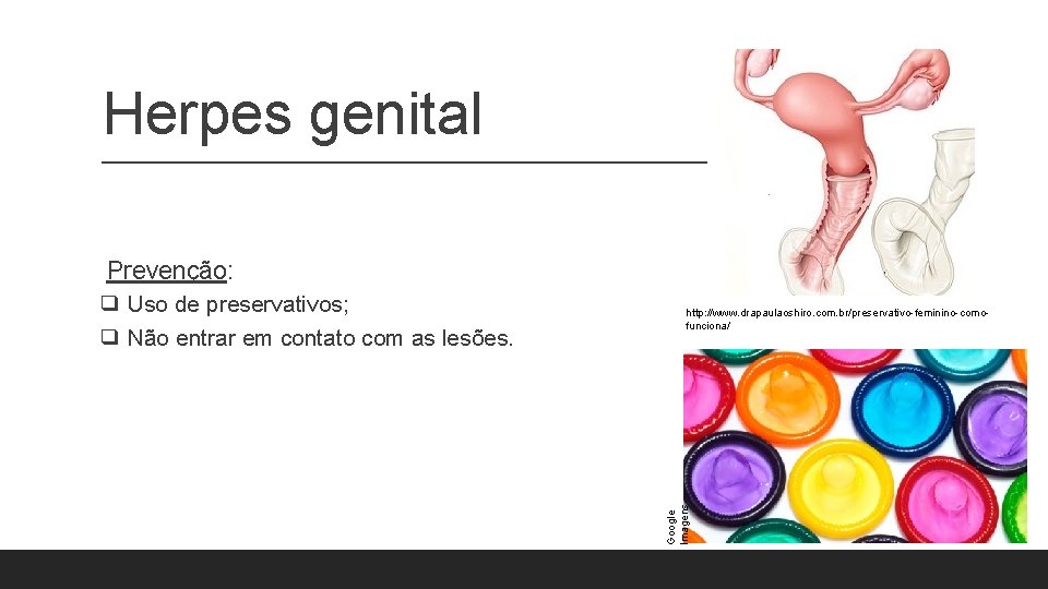Herpes genital Prevenção: http: //www. drapaulaoshiro. com. br/preservativo-feminino-comofunciona/ Google Imagens ❑ Uso de preservativos; Herpes genital Prevenção: http: //www. drapaulaoshiro. com. br/preservativo-feminino-comofunciona/ Google Imagens ❑ Uso de preservativos;