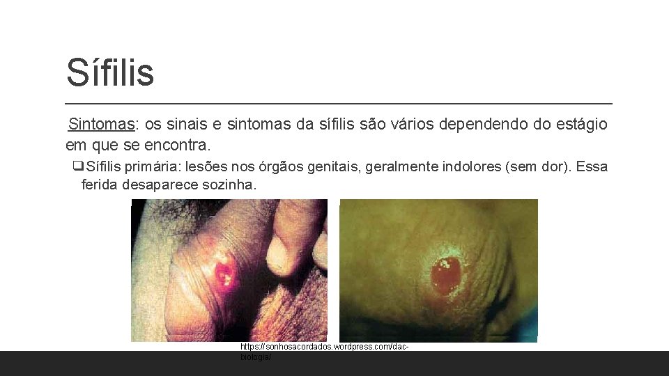 Sífilis Sintomas: os sinais e sintomas da sífilis são vários dependendo do estágio em Sífilis Sintomas: os sinais e sintomas da sífilis são vários dependendo do estágio em