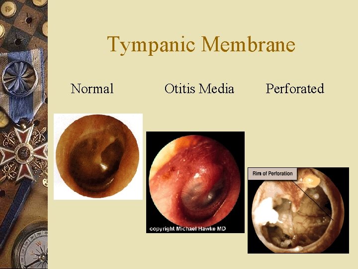 Tympanic Membrane Normal Otitis Media Perforated 