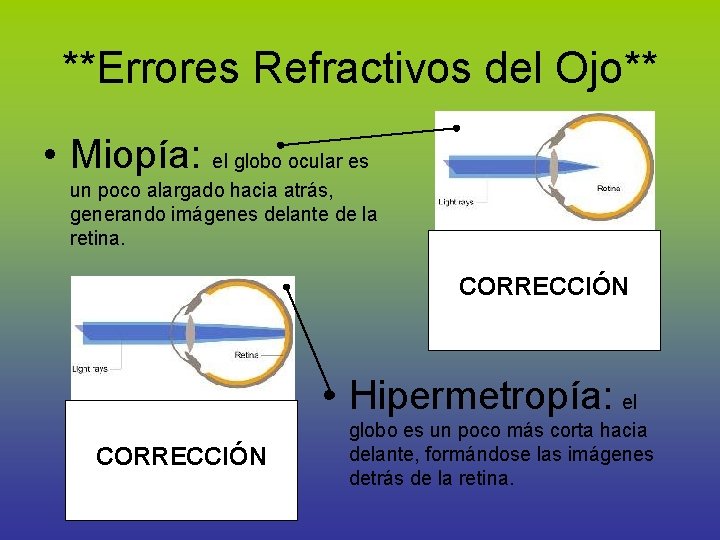 **Errores Refractivos del Ojo** • Miopía: el globo ocular es un poco alargado hacia