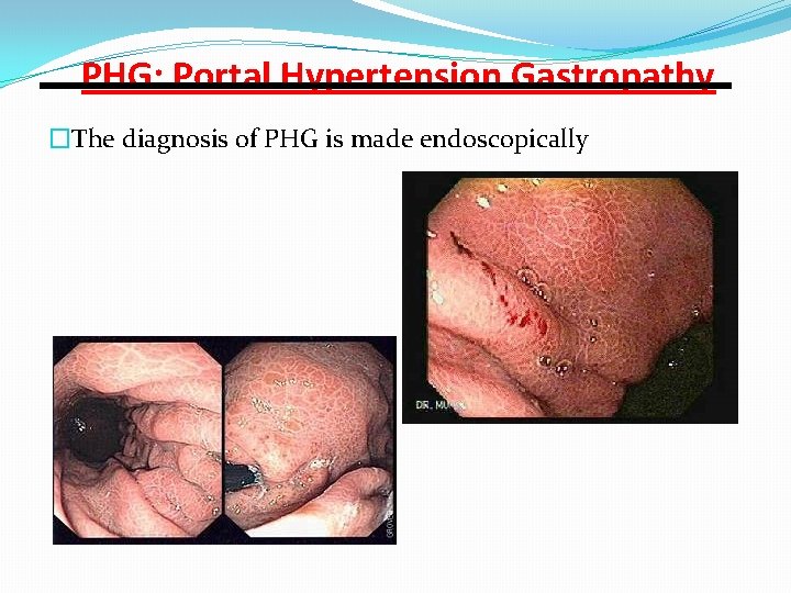 PHG: Portal Hypertension Gastropathy �The diagnosis of PHG is made endoscopically 