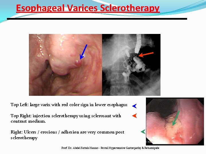 Esophageal Varices Sclerotherapy Top Left: large varix with red color sign in lower esophagus