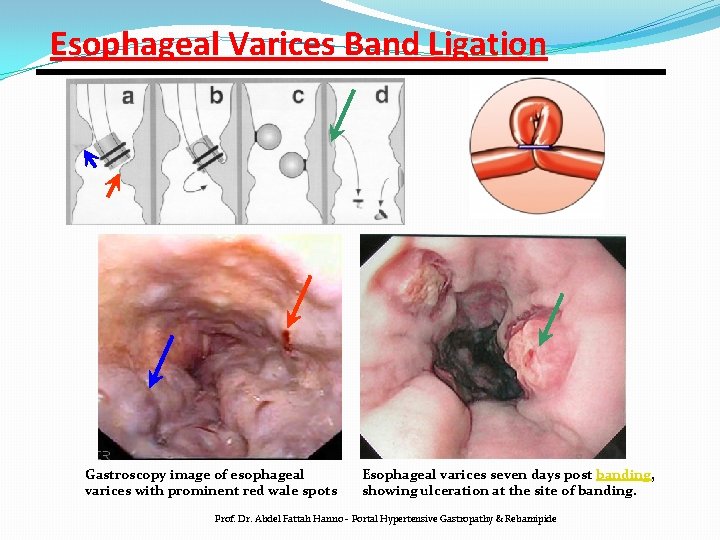 Esophageal Varices Band Ligation Gastroscopy image of esophageal varices with prominent red wale spots