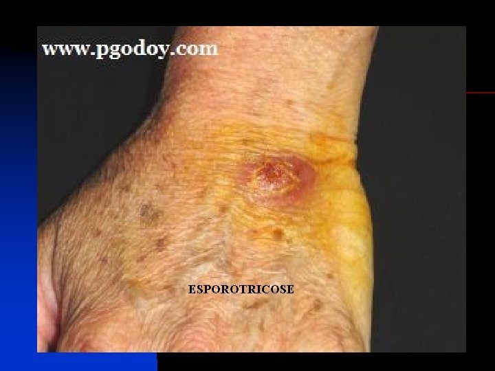 ESPOROTRICOSE 
