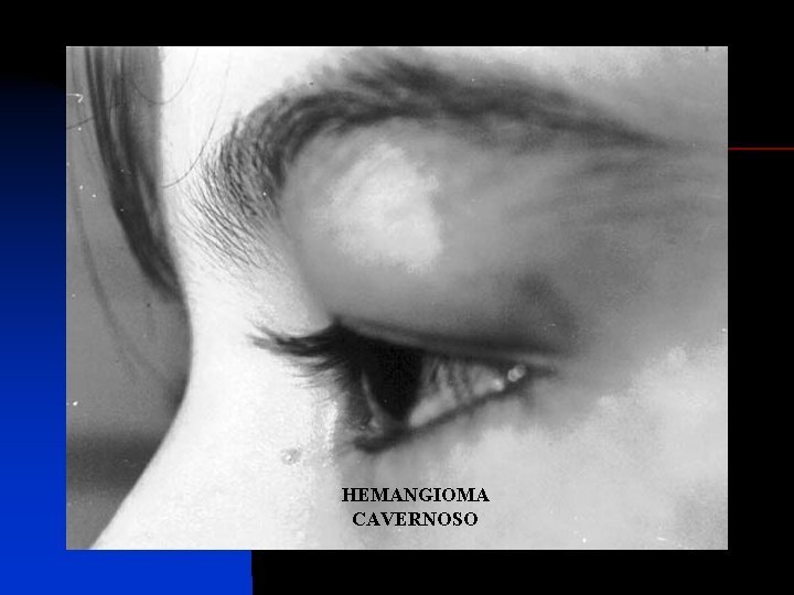 HEMANGIOMA CAVERNOSO 