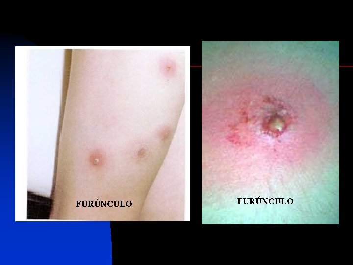 FURÚNCULO 