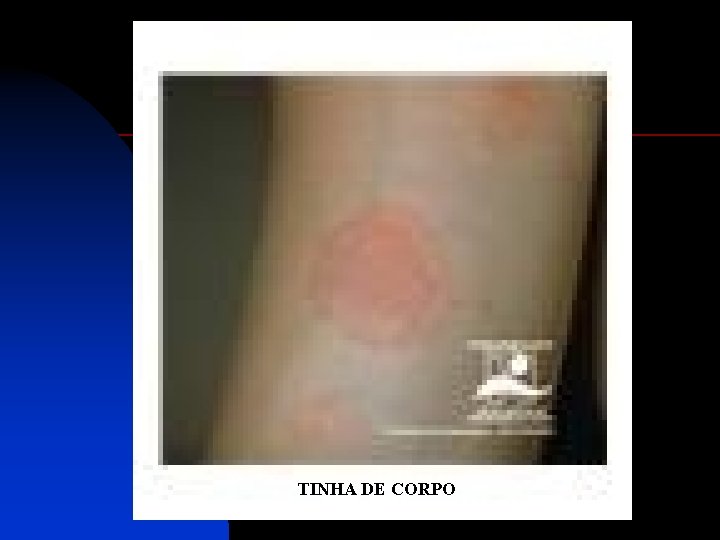 TINHA DE CORPO 