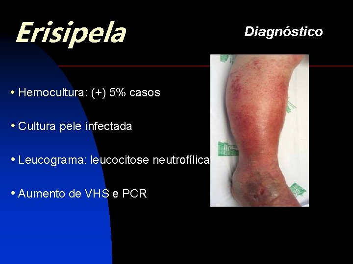 Erisipela • Hemocultura: (+) 5% casos • Cultura pele infectada • Leucograma: leucocitose neutrofílica
