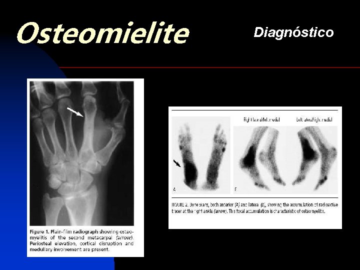 Osteomielite Diagnóstico 
