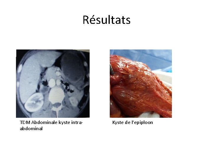 Résultats TDM Abdominale kyste intraabdominal Kyste de l’epiploon 