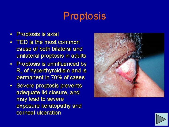 Proptosis • Proptosis is axial • TED is the most common cause of both