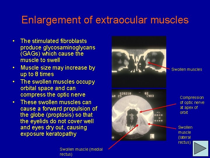 Enlargement of extraocular muscles • The stimulated fibroblasts produce glycosaminoglycans (GAGs) which cause the