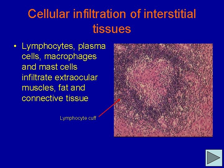 Cellular infiltration of interstitial tissues • Lymphocytes, plasma cells, macrophages and mast cells infiltrate