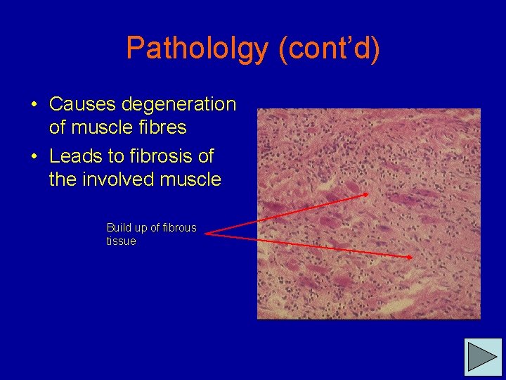 Pathololgy (cont’d) • Causes degeneration of muscle fibres • Leads to fibrosis of the