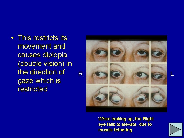  • This restricts its movement and causes diplopia (double vision) in the direction